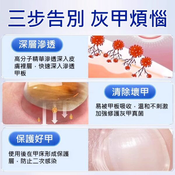 【無痛不復發】APGMA灰指甲膏：圖片 8