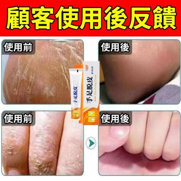 【脫皮專用】手足脫皮抑菌膏：圖片 5