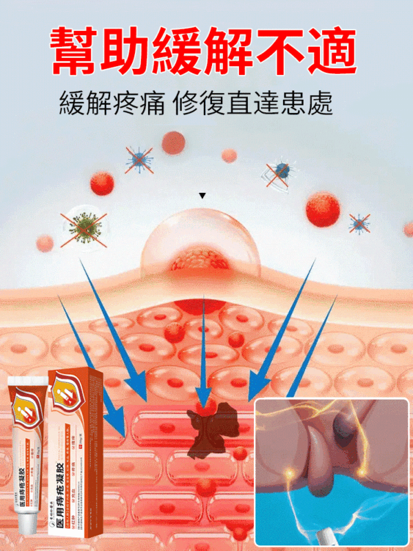 李時珍醫用痔瘡凝膠：圖片 2